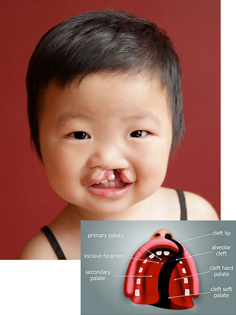 cleft lip and alveolus