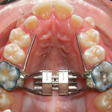 orthodontic-appliances-img3