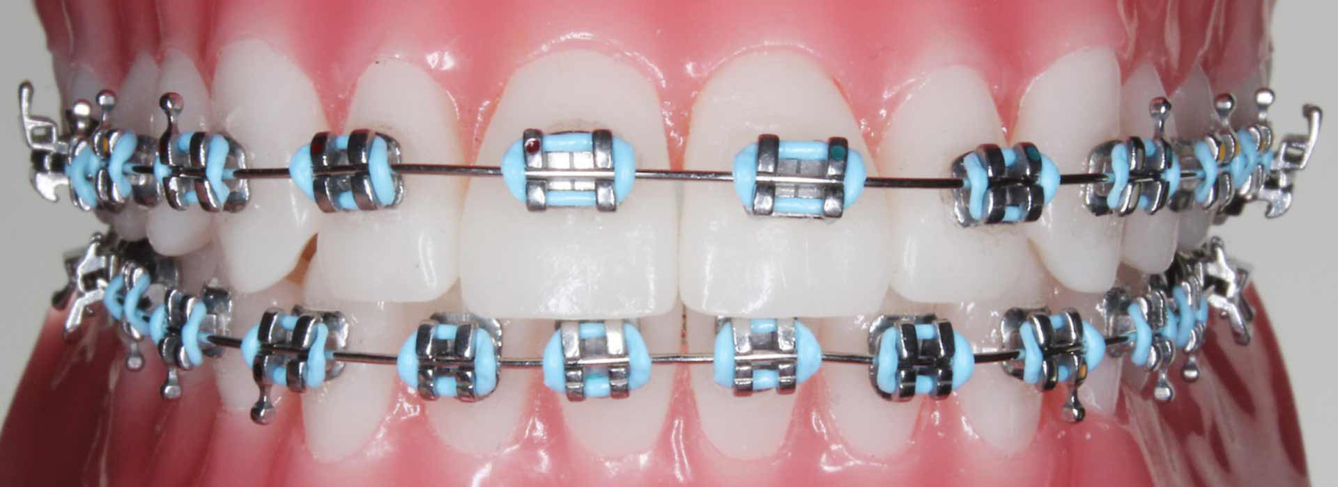 Types of Braces – Orthodontics Dental Treatment