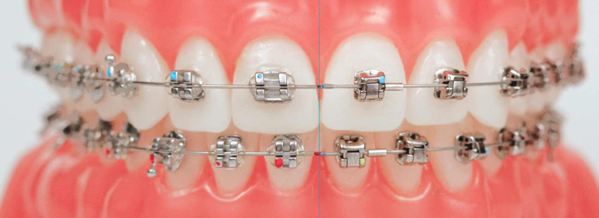 Types of Braces – Orthodontics Dental Treatment